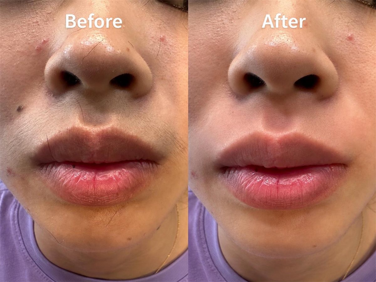 Depilación de bigote y rostro con hilo — antes y después